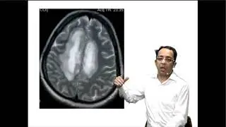 Balo's concentric Sclerosis DAMS Unplugged by Dr Sumer Sethi