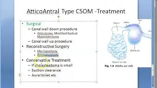 ENT AtticoAntral CSOM Treatment