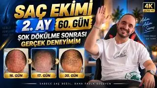 2. AY (60 Gün) Saç ekimi yaptırdım - Normalleşen görüntü dönemi 60. gün #lifestyle