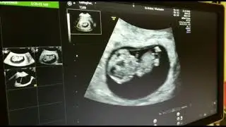 9 Weeks Ultrasound!