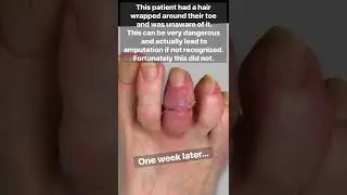 HAIR WRAPPED AROUND TOE! LEADS TO AMPUTATION?!😱 #shorts #reaction