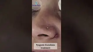Pyogenic granuloma excision!
