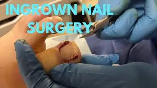 SEVERE INGROWN TOENAIL REMOVAL!