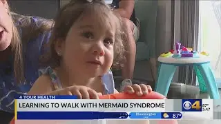 Girl with Mermaid Syndrome learning to walk