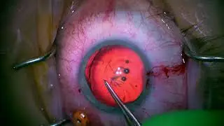 Traumatic Cataract removal with vitreous prolapse management AND atonic pupil repair