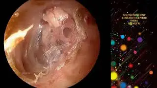 POST OP 12 WEEKS MICROSCOPE AND ENDOSCOPE ASSISTED EAR SURGERY EPITYMPANIC CHOLESTEATOMA