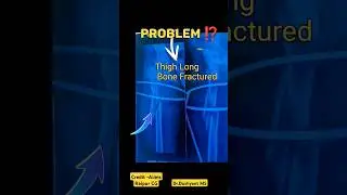 Thigh Femur Bone Fracture 🔥 हड्डी का हो गया काम 💥 #femurfracture #femur #fracturerecovery #fracture