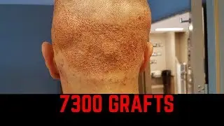 donation area after two hair transplants with 7300 grafts