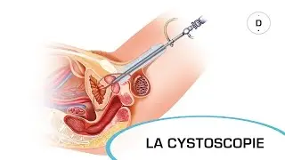 Cystoscopy - Medical Examinations