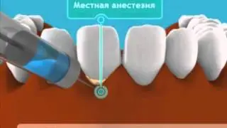 Лоскутная операция на десне