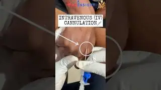 PERIPHERAL INTRAVENOUS (IV) CANNULATION #cannulation #catheter #nursing #viralvideo #viralshorts