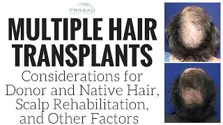 Considerations for Multiple Hair Transplants, from Donor Hair to Scalp Rehabilitation