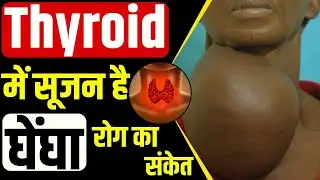 Goiter: Causes, Diagnosis, Symptoms and Treatment | क्या है घेंघा रोग  ? Dr. Kanchan Singh।