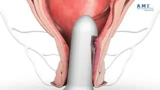 RAR Recto Anal Repair Hemorrhoid Treatment