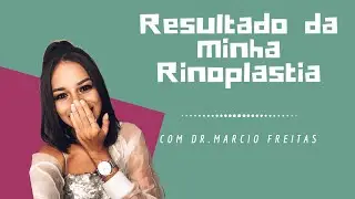 RESULTADO DA MINHA RINOPLASTIA