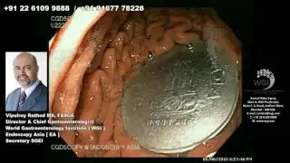 Endoscopic procedure for foreign body removal (Coin removal)