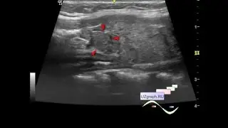 Pediatric thyroid ultrasound - Thyroiditis