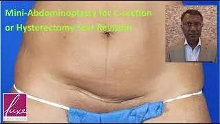 Mini-Abdominoplasty for Revision of C-Section or Hysterectomy Scars