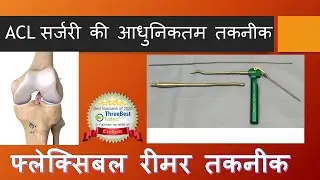 Most Advanced Technique IN ACL Reconstruction : Flexible reamer Technique (Hindi)