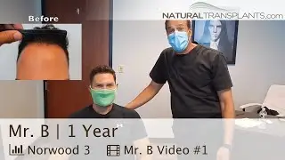 Hair Transplant 1-Year Results Before & After | Dr Harold Siegel of Natural Transplants (Mr. B)