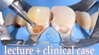 Class V Composite Restoration( Lecture + clinic case)