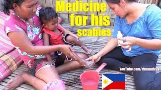 Putting Medicine on this Poor Little Filipino Boy's Feet. Treatment for His Scabies. The Philippines
