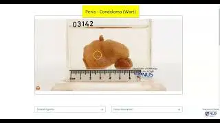 Penis - Condyloma acuminatum/Wart (Gross pathology)