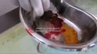 Rakta Mokshana (Jaloka) By Dr.Sandeep Rane.3gp