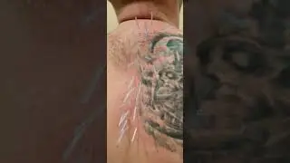 Лечение боли в плече.