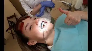 Отбеливание зубов в Куркино Belle Whitening (Южная Корея)
