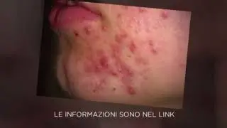 ELIMINARE I BRUFOLI GRANDI