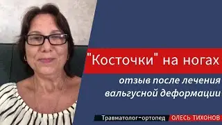 Отзыв после операции по удалению косточек на ногах вальгусной деформации у Тихонова О.А. (Москва)