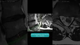 Treatment of spinal hernia. Conservative treatment of spinal hernia