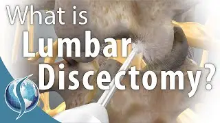 Lumbar Discectomy