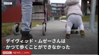 下半身まひの男性、脊椎インプラントのおかげで父親に　娘と散歩も