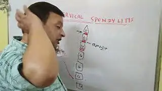 Cervical spondylitis # neck pain #back pain #cervicalpain # treatment of spondylitis #