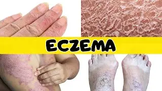 What no one told you about WHY ECZEMA appears on the skin