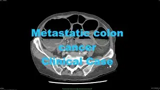 Clinical Case - metastatic colon cancer - CT - synchronous sigmoid carcinoma with liver mets