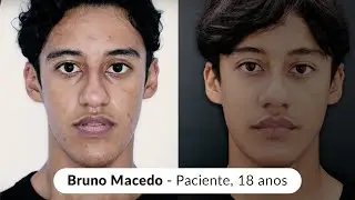 Cirurgia Ortognática - Bruno Macedo - Paciente Classe III
