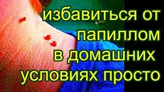 как избавиться от папиллом , в домашних условиях / удалить бородавки без хирурга. 