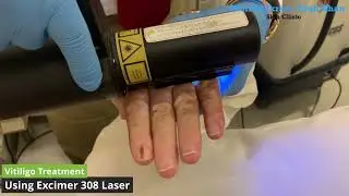 Laser Light vs. White Spots: How Excimer 308 Laser Battles Vitiligo #vitiligo #lasertreatment