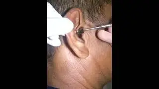 Black head removal on face - Blackheads on back treatment