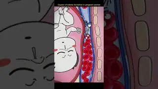 Formation in pregnant woman