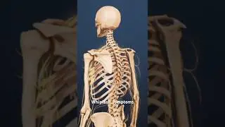 Whiplash Symptoms