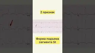 3 признака как отличить ЭКГ при ОКС от другой патологии 