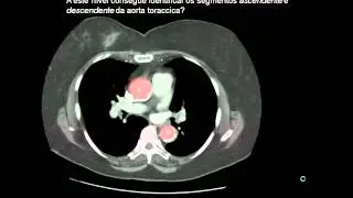 ANATOMIA MEDIASTINO