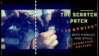 A Big Dandruff Patch Ready to Scratch