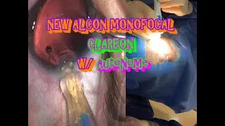 How to: CLAREON w/ AutoNoMe injector by ALCON (cataract surgery)