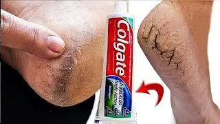 DERMATOLOGISTA ME ENSINOU COLOCAR ISSO PÉ ANTES DE DORMIR - ADEUS CASCO DE CAVALO