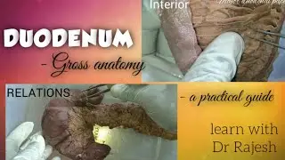 DUODENUM- Specimen demo